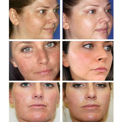 Whitening Freckles Cream Remove Melasma Dark Spots Lighten Melanin Melasma Remover Moisturizing Brighten Face Skin Care