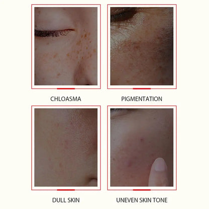 Kojic Acid Facial Serum Dark Spots Remove Whitening Brightening Essence Improve Roughness Moisturizing for Sensitive Skin Care